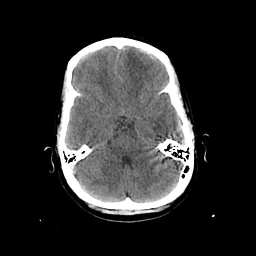 Cerebral venous throbmosis - hemorrhagic venous infarction (Radiopaedia 87318-103613 Axial non-contrast 51).jpg