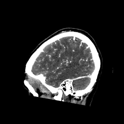 File:Cerebral venous throbmosis - hemorrhagic venous infarction (Radiopaedia 87318-103613 Sagittal CT venogram 39).jpg