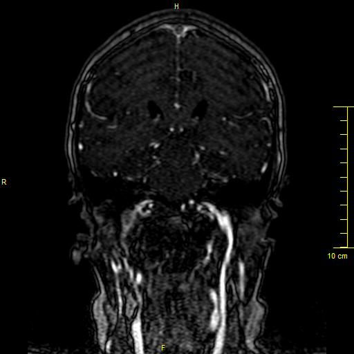 Cerebral venous thrombosis (Radiopaedia 23288-23351 MRV 92).JPG