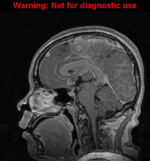 Cerebral venous thrombosis (Radiopaedia 37224-39208 Sagittal T1 C+ 76).jpg