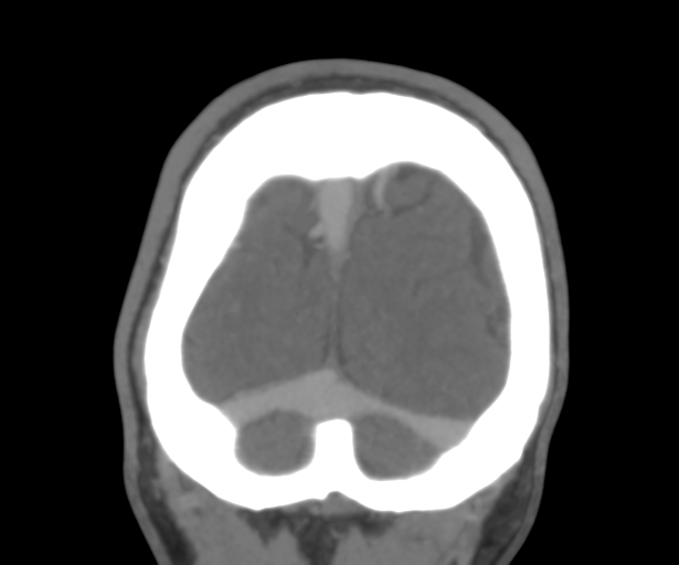 File:Cerebral venous thrombosis (Radiopaedia 38392-40467 Coronal CTA-Venogram 56).png