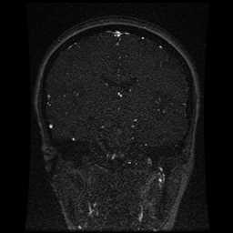 Cerebral venous thrombosis - ulcerative colitis (Radiopaedia 66049-75219 Coronal MRV 60).jpg