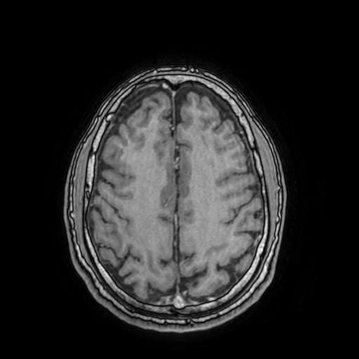 File:Cerebral venous thrombosis with secondary intracranial hypertension (Radiopaedia 89842-106957 Axial T1 C+ 127).jpg