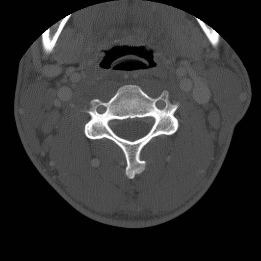 Cervical Pott disease (Radiopaedia 20374-20286 Axial bone window 68).jpg