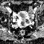 File:Cervical adenocarcinoma (Radiopaedia 65011-73985 Axial ADC 17).jpg