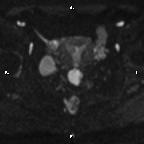 Cervical adenocarcinoma (Radiopaedia 65011-73985 Axial DWI 47).jpg