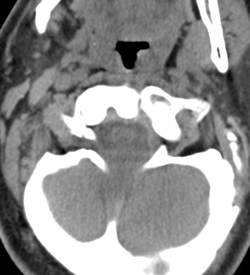 File:Cervical canal stenosis due to ossification of the posterior longitudinal ligament (Radiopaedia 47260-51823 Axial non-contrast 13).png