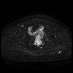 File:Cervical carcinoma (Radiopaedia 85405-101028 Axial DWI 49).jpg