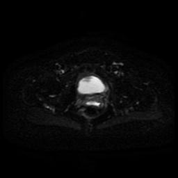 Cervical carcinoma (Radiopaedia 85405-101028 Axial DWI 6).jpg