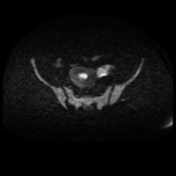 Cervical carcinoma (Radiopaedia 88010-104555 Axial DWI 57).jpg