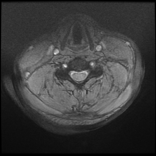 Cervical disc extrusion (Radiopaedia 59074-66364 F 26).jpg