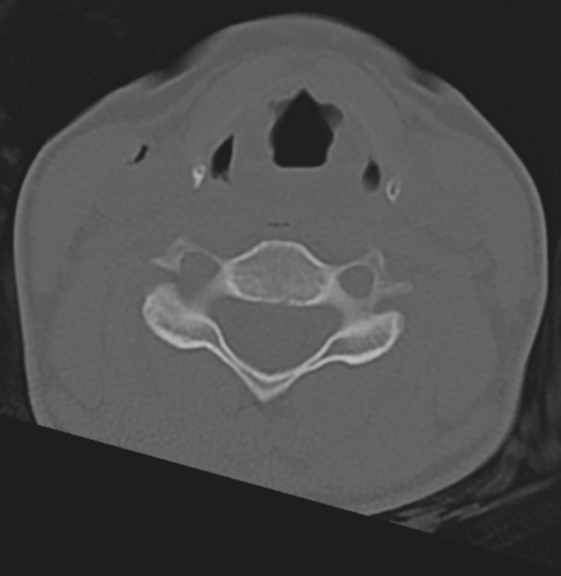 File:Cervical disc replacement (Radiopaedia 37383-39205 Axial bone window 3).png