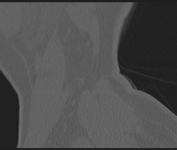 File:Cervical disc replacement (Radiopaedia 44025-47541 Sagittal bone window 3).png