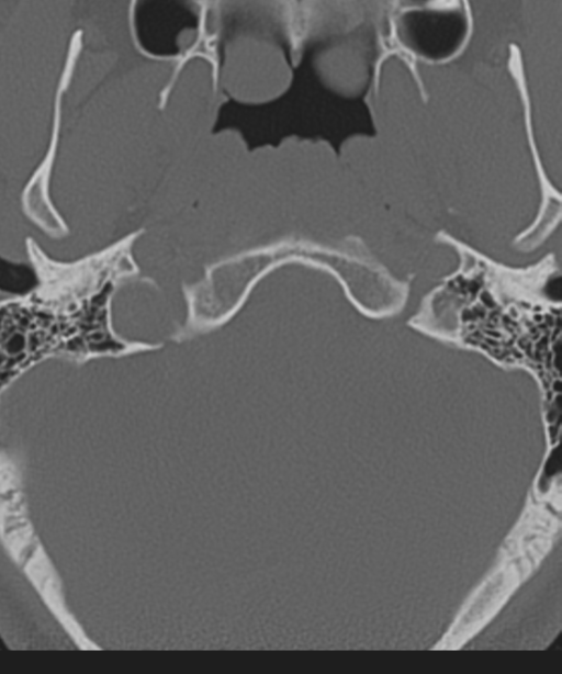 Cervical intercalary bone (Radiopaedia 35211-36748 Axial bone window 5).png