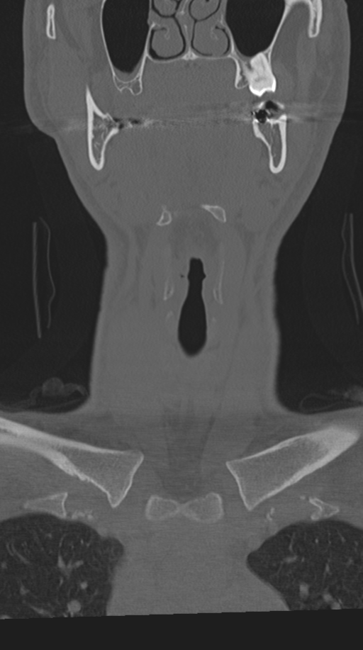 Cervical intercalary bone (Radiopaedia 35211-36748 Coronal bone window 4).png