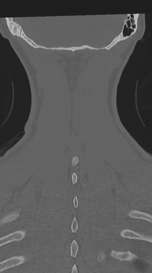 Cervical intercalary bone (Radiopaedia 35211-36748 Coronal bone window 68).png