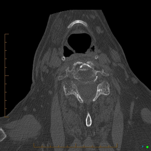 File:Cervical spine fracture - ankylosing spondylitis (Radiopaedia 76835-88706 Axial bone window 136).jpg