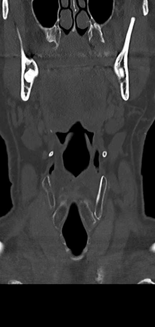 Cervical spine fracture - chalk stick (Radiopaedia 39116-41323 Coronal bone window 4).png