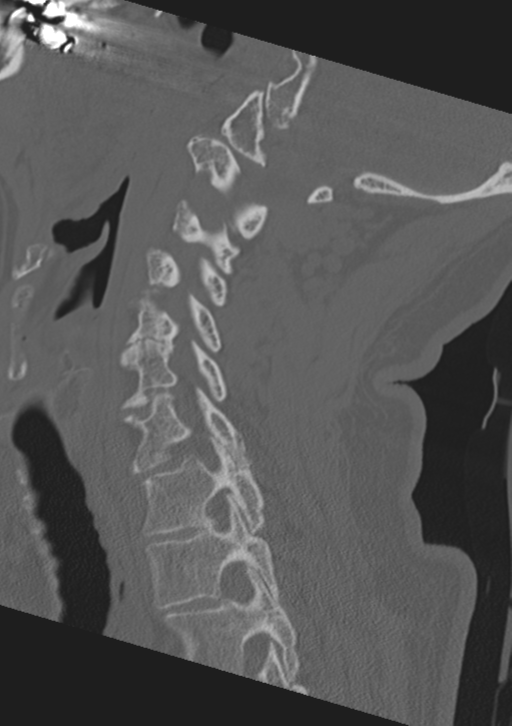 Cervical spine fractures with vertebral artery dissection (Radiopaedia 53296-59268 Sagittal bone window 26).png