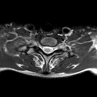 File:Cervical spine posterior ligamentous complex rupture (Radiopaedia 63486-72103 Axial T2 2).jpg