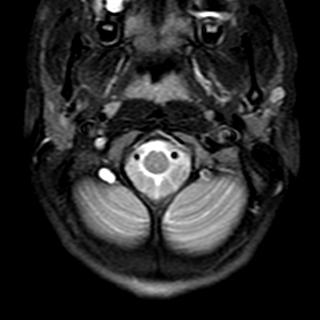 File:Cervical spine posterior ligamentous complex rupture (Radiopaedia 63486-72103 Axial T2 25).jpg