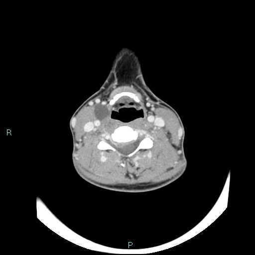 File:Cervical thymic cyst (Radiopaedia 88632-105335 C 59).jpg