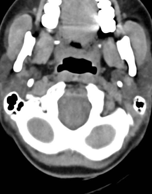 Cervical tuberculous spondylitis (Radiopaedia 39149-41365 Axial non-contrast 7).png