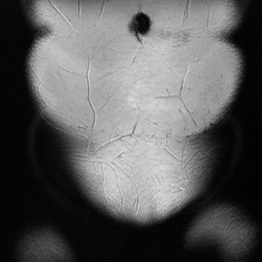 File:Cesarian section scar endometriosis (Radiopaedia 66520-75799 Coronal T2 1).jpg