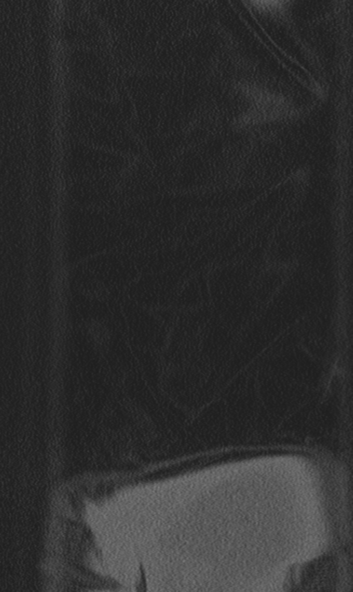 Chance fracture (Radiopaedia 40360-42912 Coronal bone window 81).png