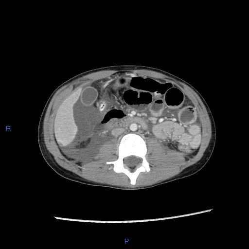 File:Chance fracture with duodenal and pancreatic lacerations (Radiopaedia 43477-46864 A 20).jpg