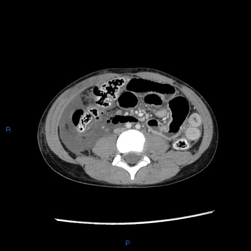 File:Chance fracture with duodenal and pancreatic lacerations (Radiopaedia 43477-46864 A 26).jpg