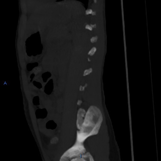 File:Chance fracture with duodenal and pancreatic lacerations (Radiopaedia 43477-50042 Sagittal bone window 1).jpg