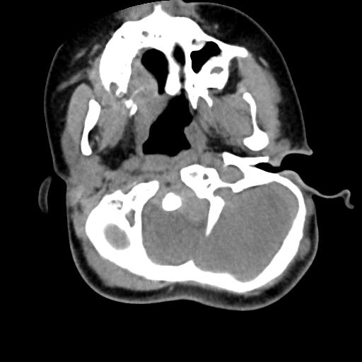 Chiari I with syrinx and skull base anomalies (Radiopaedia 89444-106412 Axial non-contrast 40).jpg