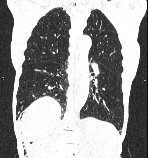 Chilaiditi sign (Radiopaedia 88839-105611 Coronal lung window 42).jpg