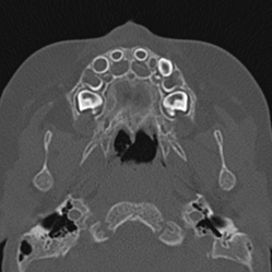 Choanal atresia (Radiopaedia 88525-105975 Axial bone window 11).jpg