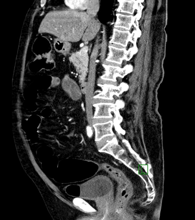 Cholangiocarcinoma with cerebral metastases (Radiopaedia 83519-98629 F 66).jpg