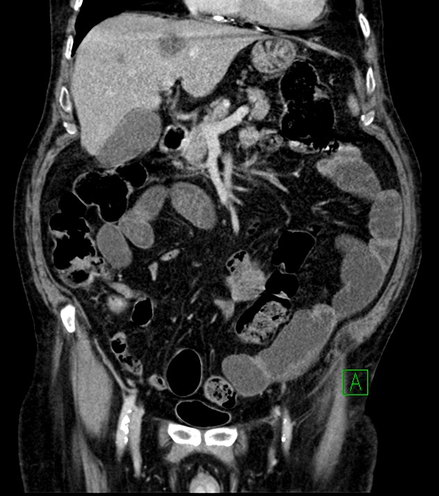 Cholangiocarcinoma with cerebral metastases (Radiopaedia 83519-98629 G 32).jpg