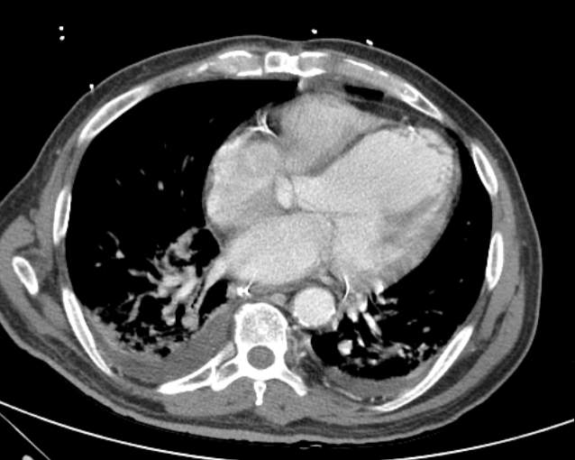 Cholecystitis - perforated gallbladder (Radiopaedia 57038-63916 A 6).jpg
