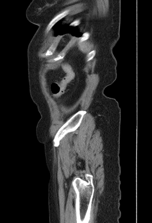 Cholecystoduodenal fistula due to calculous cholecystitis with gallstone migration (Radiopaedia 86875-103077 F 3).jpg