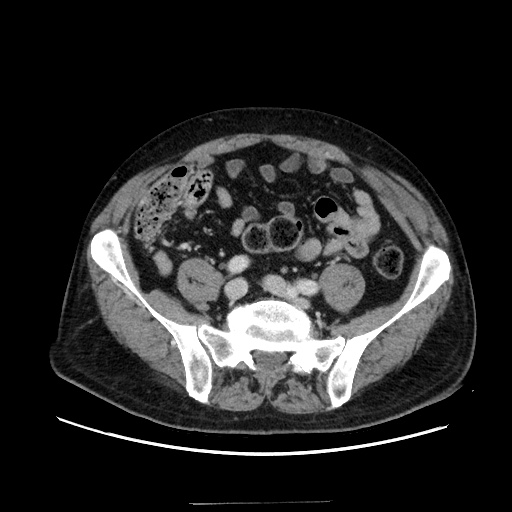 Choledocholiathiasis with normal caliber common bile duct (Radiopaedia 75368-86632 A 136).jpg