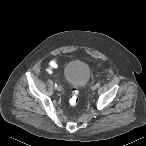 File:Choledocholithiasis and gastric polyp (Radiopaedia 48856-53895 Axial non-contrast 73).png