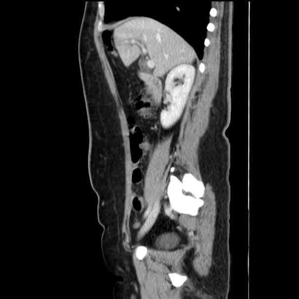 Choledocholithiasis on CT and MRI (Radiopaedia 24825-25087 D 24).jpg