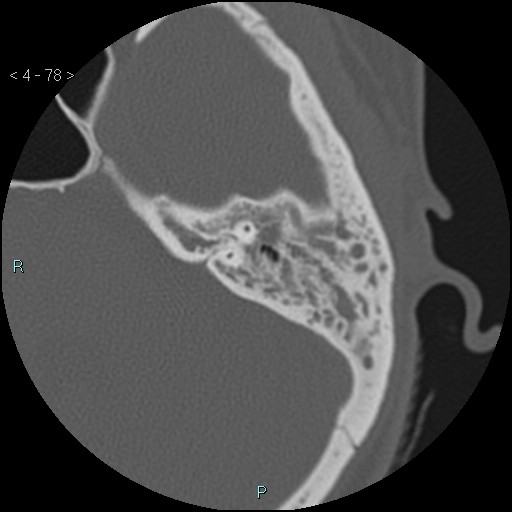 Cholesterol granuloma of the petrous apex (Radiopaedia 64358-73141 Axial bone window 38).jpg