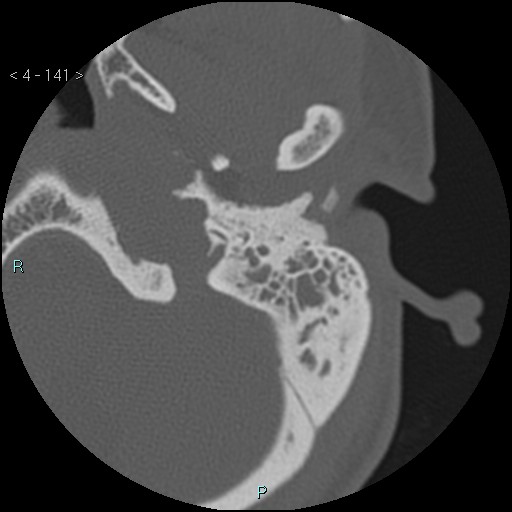 Cholesterol granuloma of the petrous apex (Radiopaedia 64358-73141 Axial bone window 68).jpg