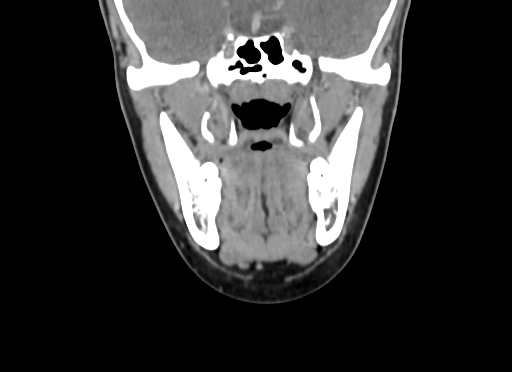 Chondroblastic osteosarcoma (Radiopaedia 67363-76741 D 53).jpg