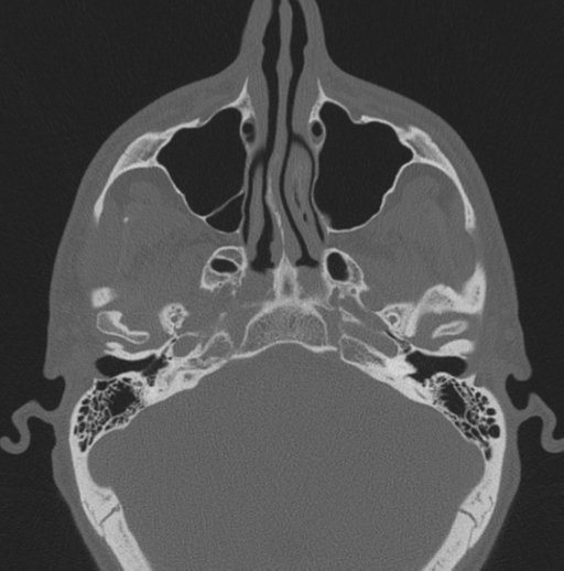 Chondrosarcoma (clivus) (Radiopaedia 46895-51425 Axial bone window 53).png