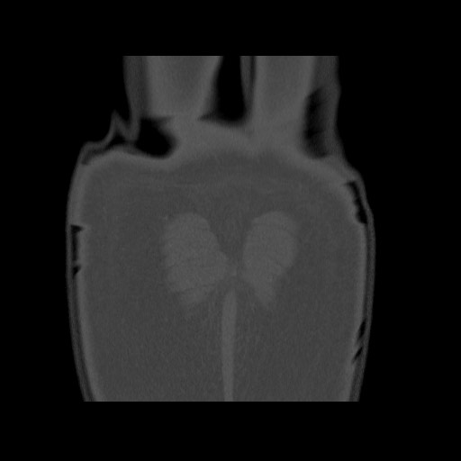 Chondrosarcoma of iliac wing (Radiopaedia 63861-72599 Coronal bone window 110).jpg