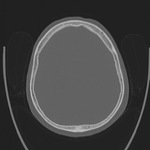 Chondrosarcoma of skull base- grade II (Radiopaedia 40948-43653 Axial bone window 34).png