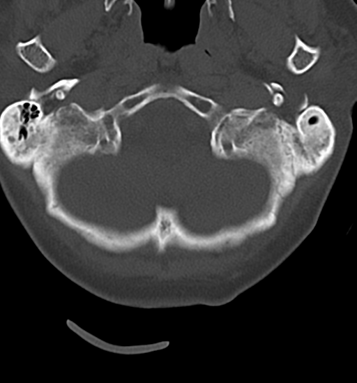 Chordoma (C4 vertebra) (Radiopaedia 47561-52188 Axial bone window 3).png