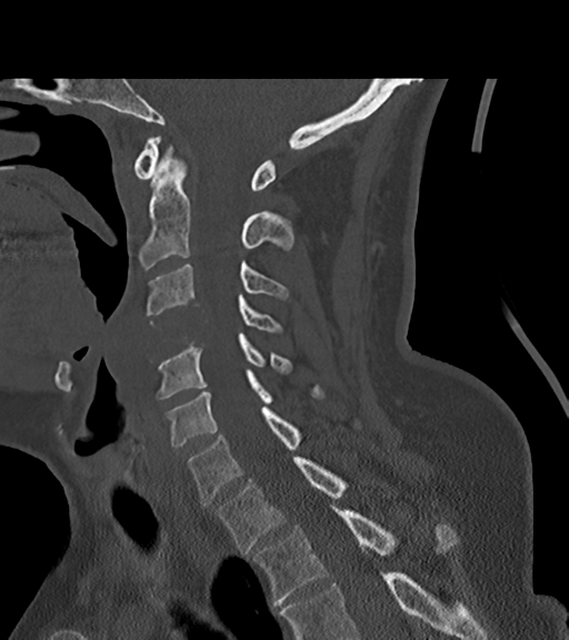 File:Chordoma (C4 vertebra) (Radiopaedia 47561-52188 Sagittal bone window 43).png